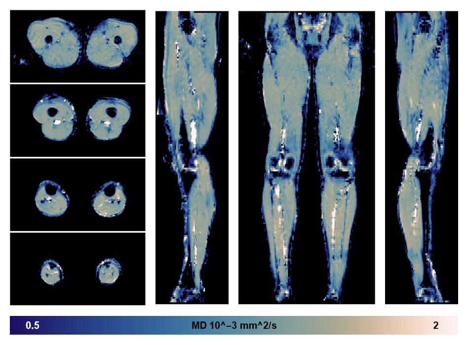 IVIM corrected whole leg muscle mean diffusivity obtained from diffusion tensor imaging.